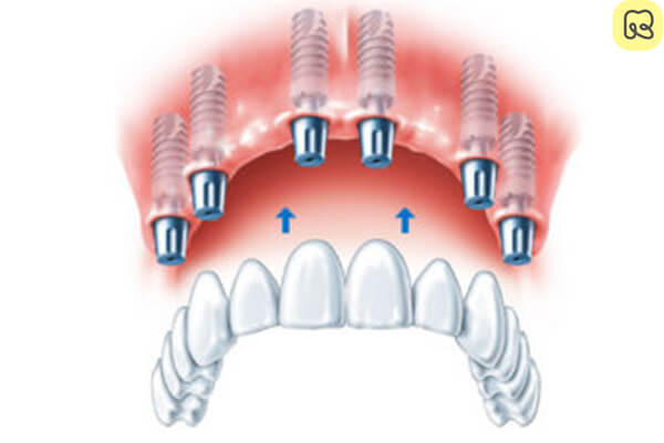 Trồng răng implant có nguy hiểm không? Những điều bạn cần biết trước khi quyết định 9