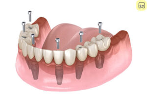 Trồng răng implant có nguy hiểm không? Những điều bạn cần biết trước khi quyết định 2