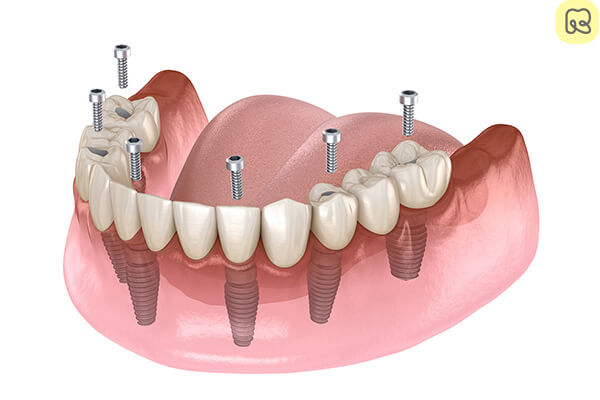 Trồng răng implant có nguy hiểm không? Những điều bạn cần biết trước khi quyết định 7