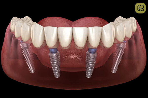 Trồng răng implant có nguy hiểm không? Những điều bạn cần biết trước khi quyết định 8