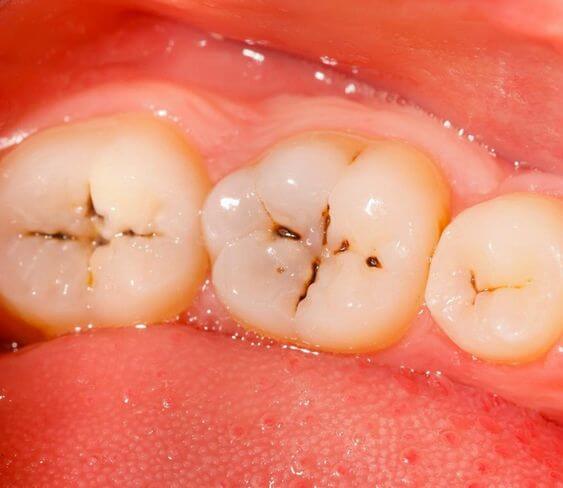 6 cách trị sâu răng hiệu quả và an toàn tại nhà 1