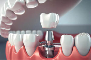 Trồng răng implant trả góp - Giải pháp tiết kiệm chi phí và hiệu quả cho người mất răng 1
