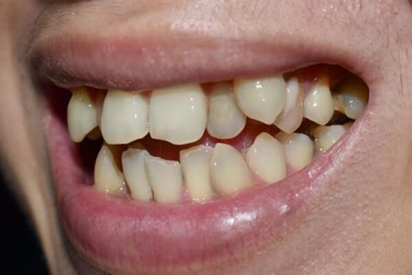 Răng khấp khểnh là gì? Nguyên nhân và cách điều trị hiệu quả nhất 4