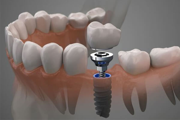 Trồng răng implant trả góp - Giải pháp tiết kiệm chi phí và hiệu quả cho người mất răng 8
