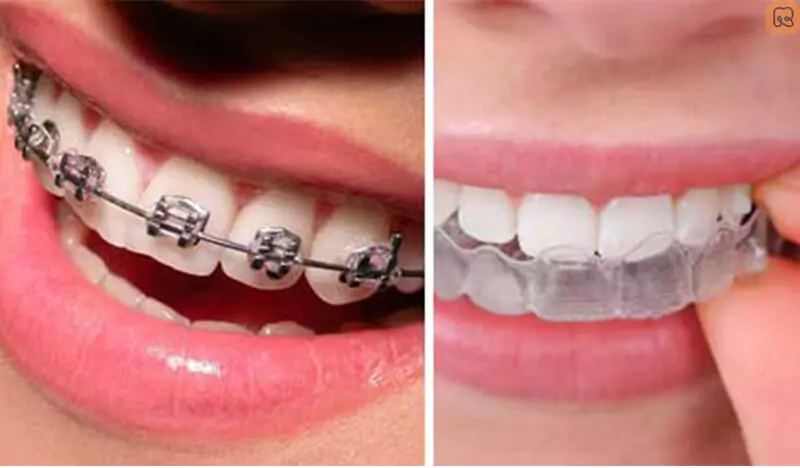 Niềng răng hay bọc sứ: Cách nào tốt hơn cho nụ cười của bạn? 1