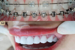 Bọc răng sứ có niềng răng được không 2
