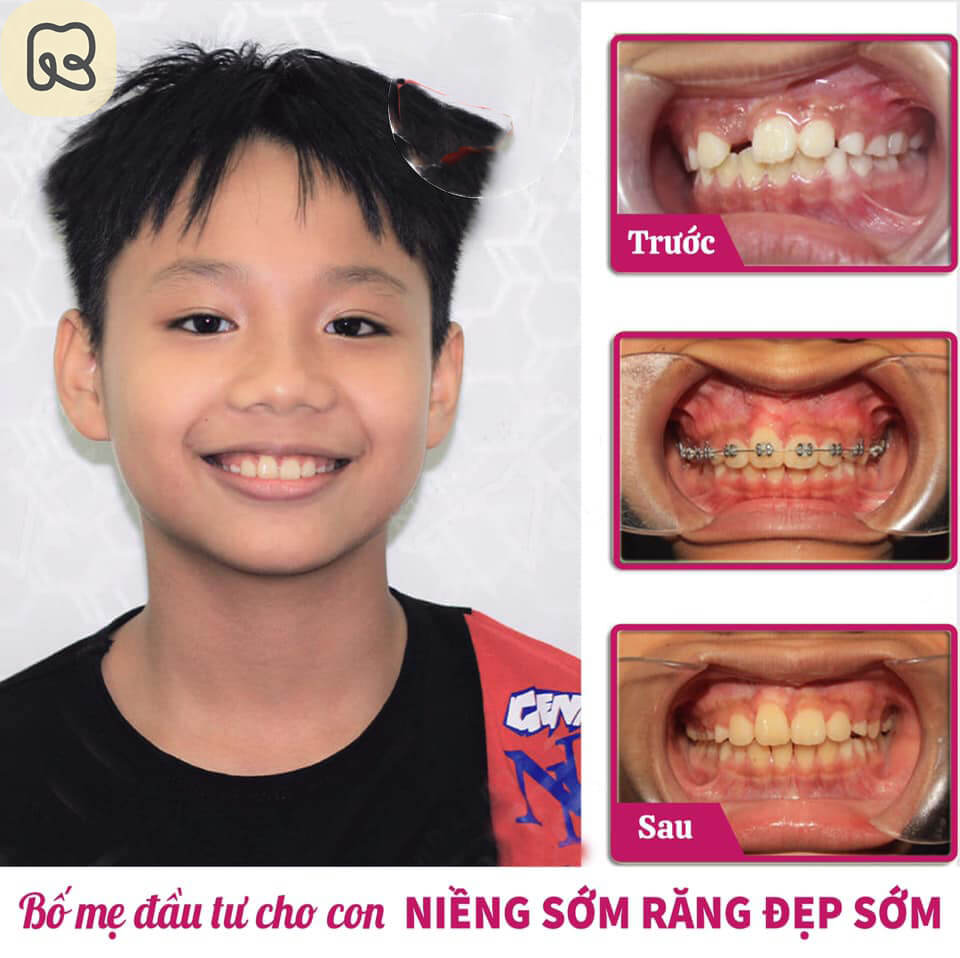 Độ tuổi niềng răng