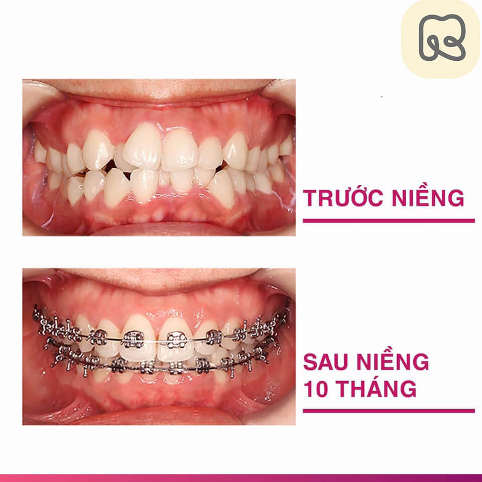 Thời gian niềng răng bao lâu 