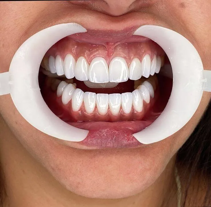 Nhổ Răng Số 4 Có Bị Hóp Má Không? Giải Đáp Toàn Diện & Cách Phòng Ngừa Hiệu Quả Từ Chuyên Gia Ruby Dental 11
