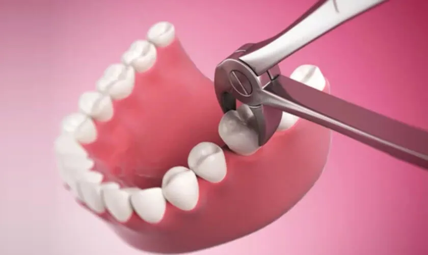 Nhổ Răng Số 4 Có Bị Hóp Má Không? Giải Đáp Toàn Diện & Cách Phòng Ngừa Hiệu Quả Từ Chuyên Gia Ruby Dental 8
