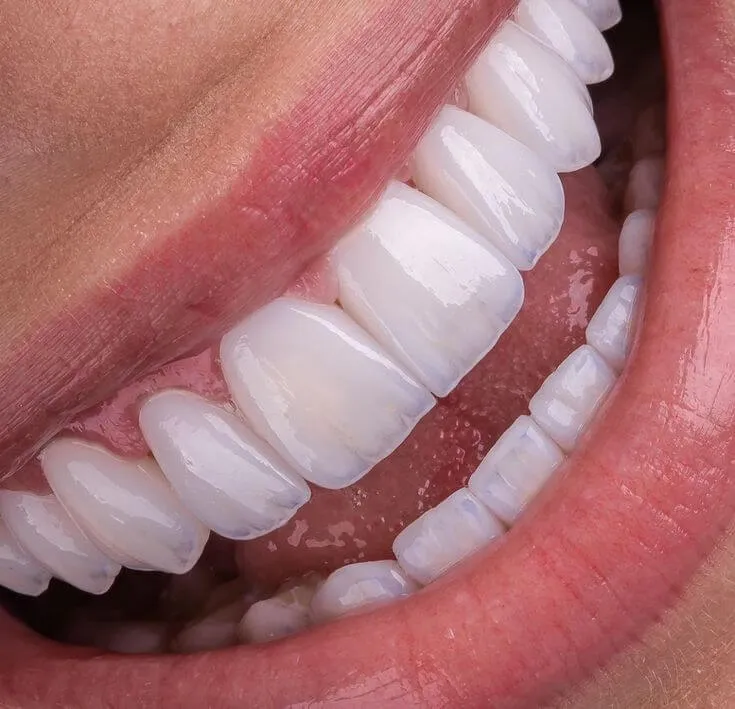 Nhổ Răng Số 4 Có Bị Hóp Má Không? Giải Đáp Toàn Diện & Cách Phòng Ngừa Hiệu Quả Từ Chuyên Gia Ruby Dental 1