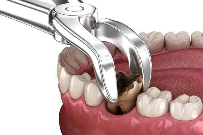 Nhổ Răng Số 4 Có Bị Hóp Má Không? Giải Đáp Toàn Diện & Cách Phòng Ngừa Hiệu Quả Từ Chuyên Gia Ruby Dental 7
