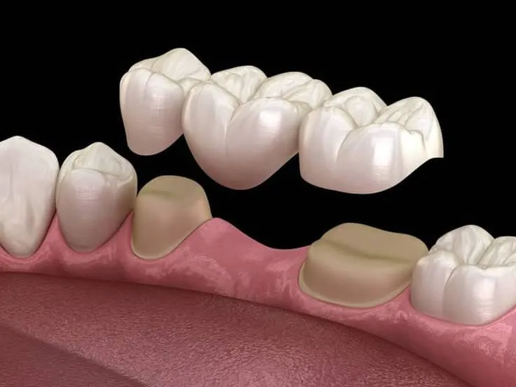 Nhổ Răng Số 4 Có Bị Hóp Má Không? Giải Đáp Toàn Diện & Cách Phòng Ngừa Hiệu Quả Từ Chuyên Gia Ruby Dental 10