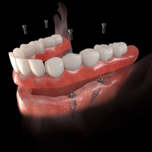 trồng răng implant mất bao lâu