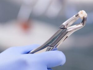 Khi nào nên nhổ răng hàm