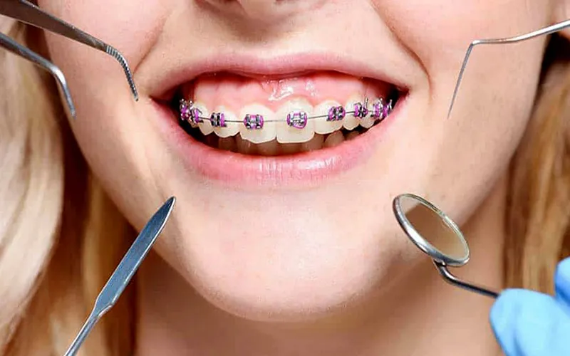 Bắt Vít Niềng Răng Có Đau Không? Giải Đáp Mọi Thắc Mắc Về Thời Gian & Hiệu Quả 14