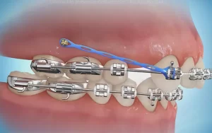 Bắt Vít Niềng Răng Có Đau Không? Giải Đáp Mọi Thắc Mắc Về Thời Gian & Hiệu Quả 1