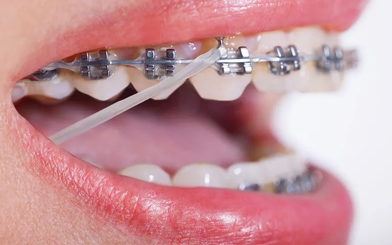 Bắt Vít Niềng Răng Có Đau Không? Giải Đáp Mọi Thắc Mắc Về Thời Gian & Hiệu Quả 11