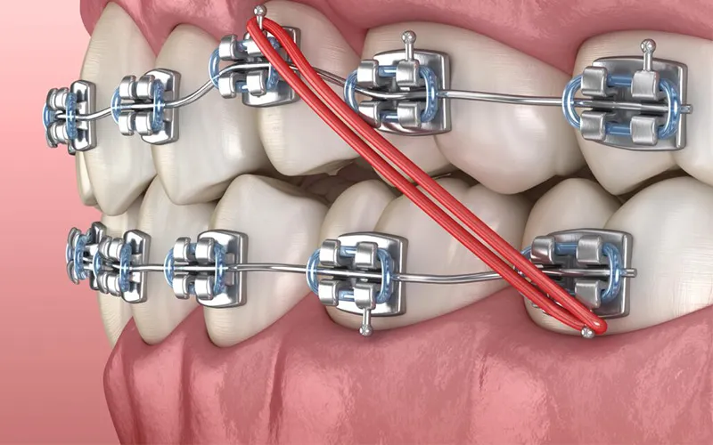 Bắt Vít Niềng Răng Có Đau Không? Giải Đáp Mọi Thắc Mắc Về Thời Gian & Hiệu Quả 10