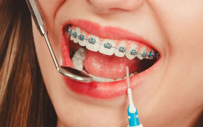 Bắt Vít Niềng Răng Có Đau Không? Giải Đáp Mọi Thắc Mắc Về Thời Gian & Hiệu Quả 13