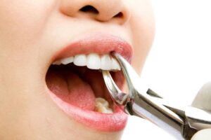 Nhổ răng cấm có nguy hiểm không? 17