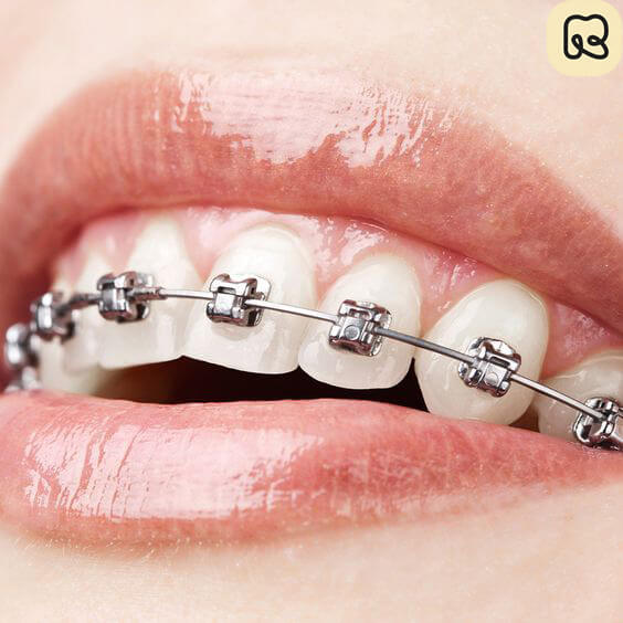 Niềng răng mắc cài kim loại