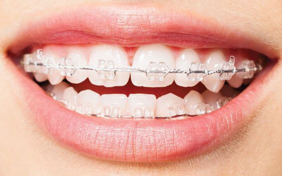 Niềng răng mắc cài sứ