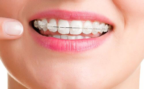 Niềng răng mắc cài tự buộc