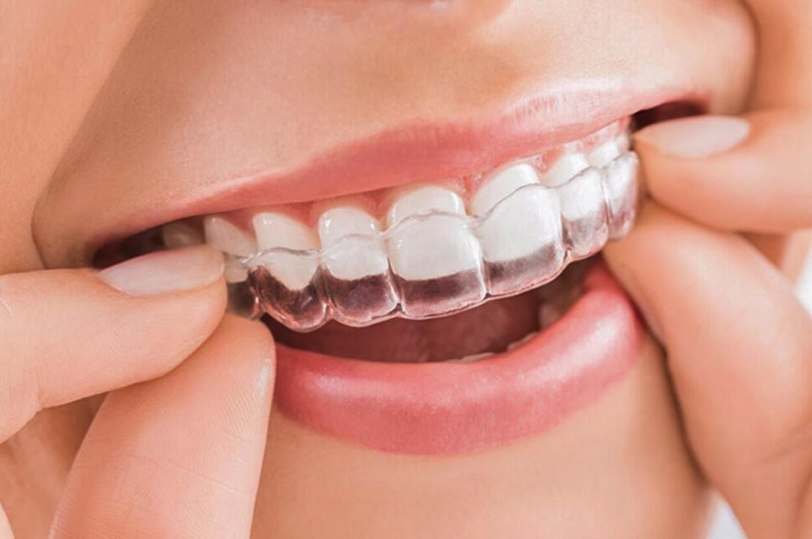 Niềng răng với khay trong suốt