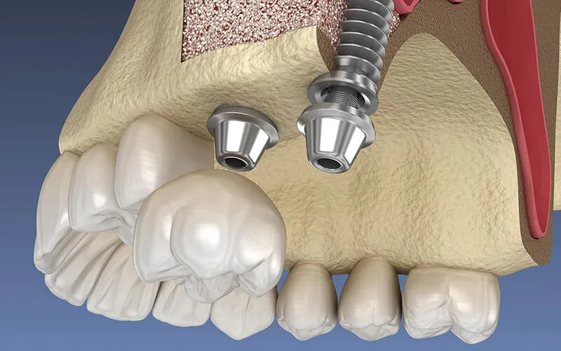 Ghép Xương Răng Là Gì? Quy Trình, Chi Phí Và Kinh Nghiệm 9
