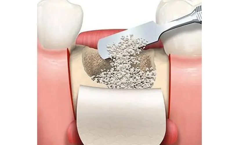 Ghép Xương Răng Là Gì? Quy Trình, Chi Phí Và Kinh Nghiệm 10