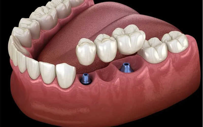Ghép Xương Răng Là Gì? Quy Trình, Chi Phí Và Kinh Nghiệm 8