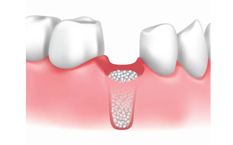 Ghép Xương Răng Là Gì? Quy Trình, Chi Phí Và Kinh Nghiệm 11