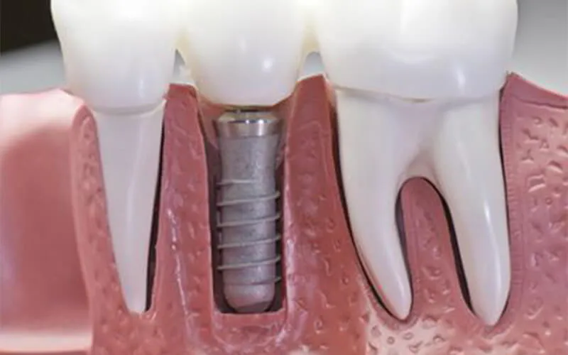 Ghép Xương Răng Là Gì? Quy Trình, Chi Phí Và Kinh Nghiệm 12
