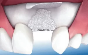 Ghép Xương Răng Là Gì? Quy Trình, Chi Phí Và Kinh Nghiệm 1